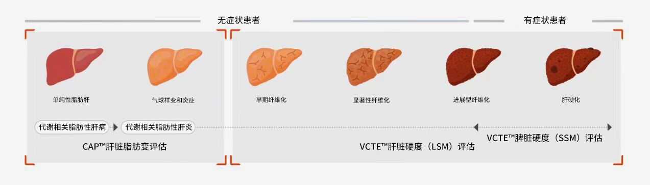 FibroScan® examination can provide a basis fortreatment decisions in various liver diseases