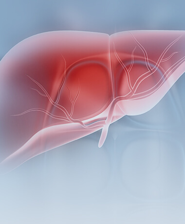 Solutions for people at high risk of liver cancer